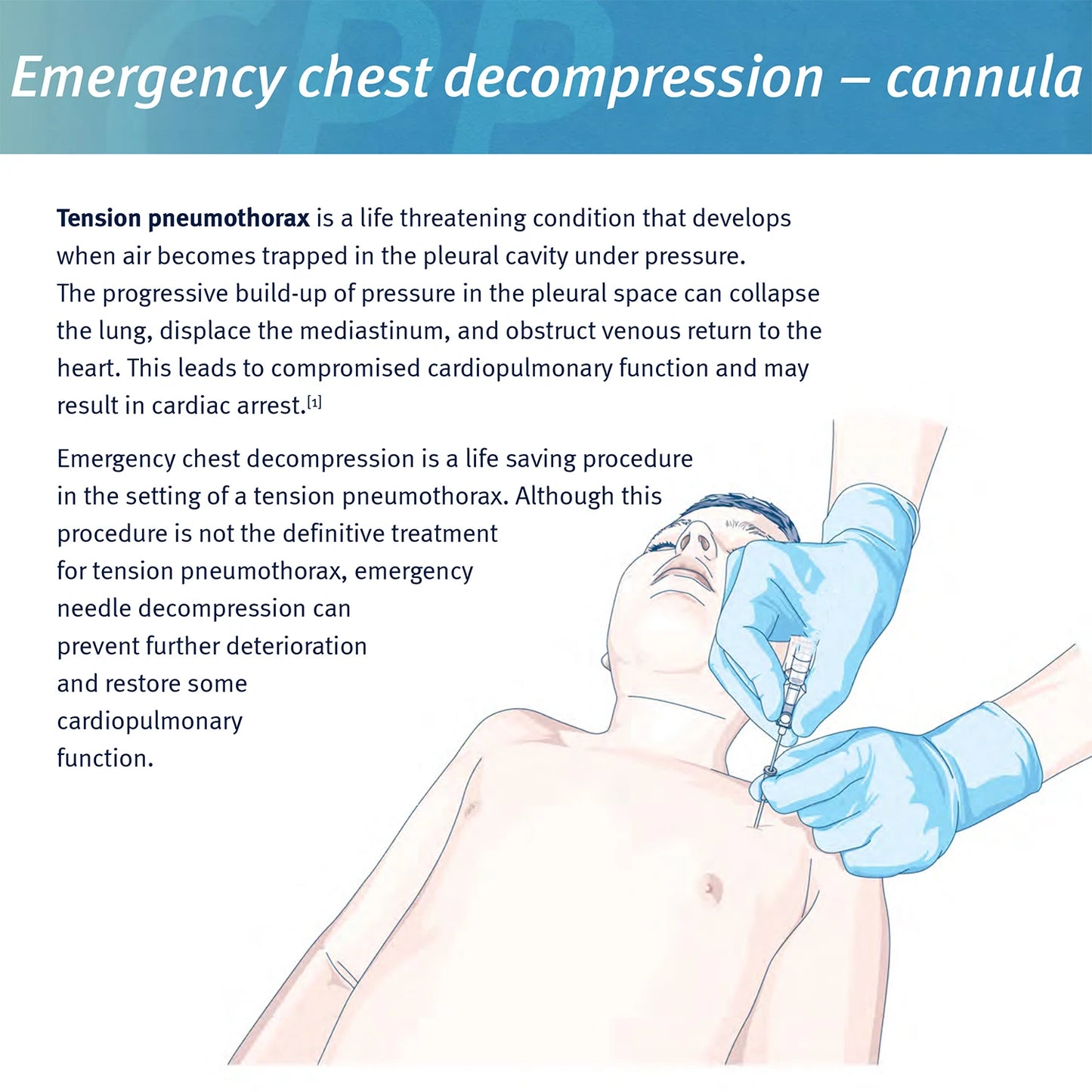 Rescue Pneumothorax Needle Trauma Medical Chest  Needle 50g Needle Decompression.